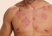 Lupus: Una enfermedad cada vez más entendida